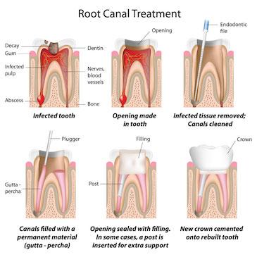 educational graphic of a root canal