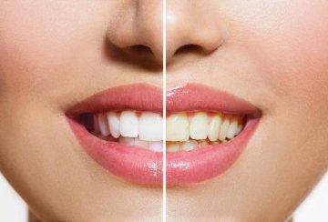 teeth whitening results in hampton park