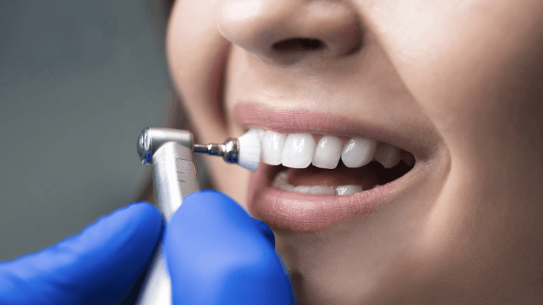 Close-up of a dentist polishing a patient’s teeth with a professional cleaning tool, removing plaque