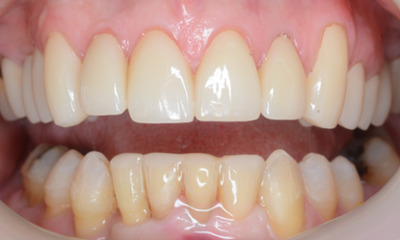 After treatment - Clear Aligners and Crowns/Veneers 