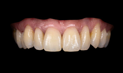 After treatment - Dark Triangle Closure with Composite Veneers