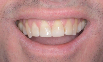 After treatment - Edge Bonding for Chipped Teeth