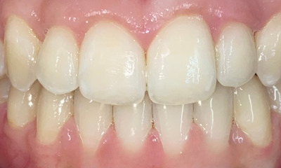 After treatment - Fixed Braces