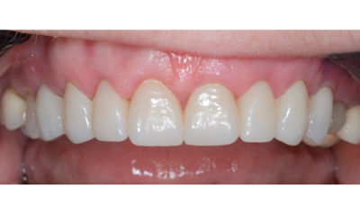 After treatment - Gum Lift, Crown and Veneers 