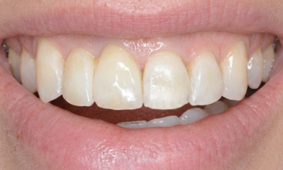 After treatment - Orthodontic and Dental Implant Treatment