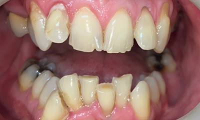 Before treatment - Clear Aligners and Crowns/Veneers 