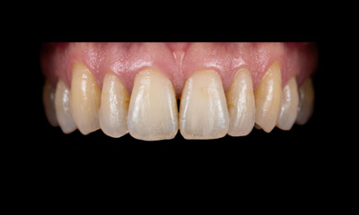 Before treatment - Dark Triangle Closure with Composite Veneers
