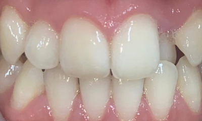 Before treatment - Fixed Braces