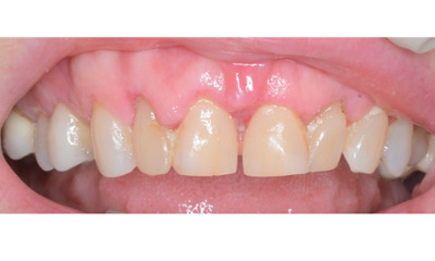 Before treatment - Gum Lift, Crown and Veneers 