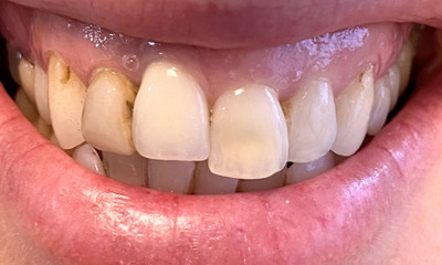 Before treatment - Orthodontic and Dental Implant Treatment